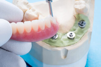 ¿Son para mí los implantes dentales?